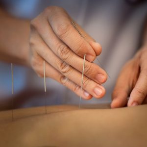 Read more about the article Discover the Benefits of Acupuncture for Pain Relief